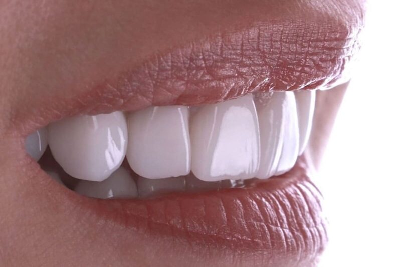 Things to know more about veneers in Turkey
