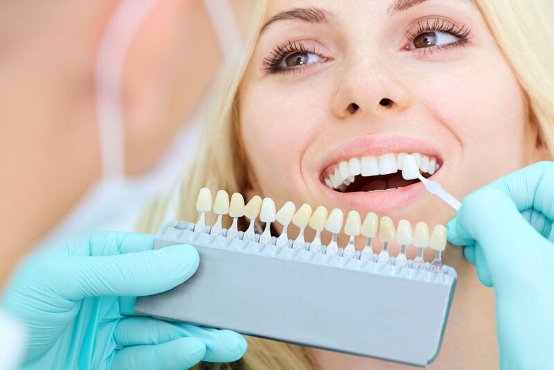 Veneers need proper care