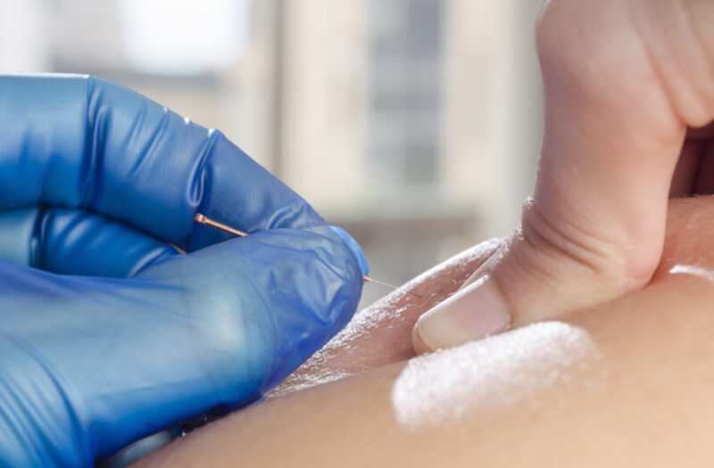 How Is Dry Needling Carried Out