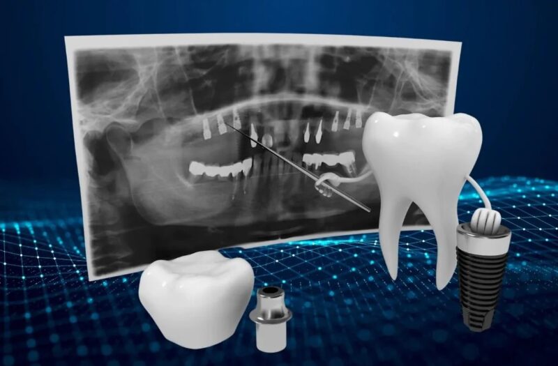 Implant Planning And Digital Dentistry